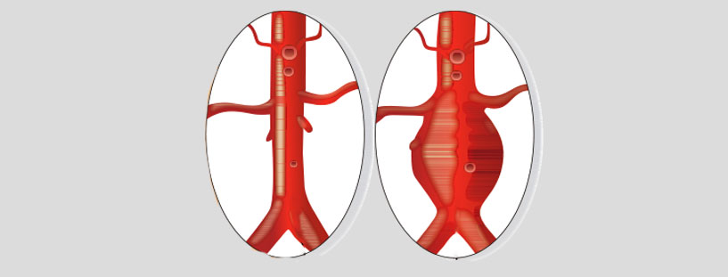 vascular-abc-imagem-interna-Aneurisma