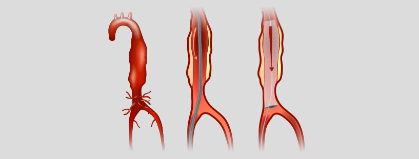 vascular-abc-imagem-interna-tratamentos-complexos-arteriais